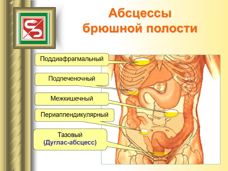 Абсцессы брюшной полости Поддиафрагмальный Подпеченочный Межкишечный Периаппендикулярный Тазовый (Дуглас-абсцесс)